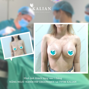 Hình ảnh trước và sau khi thực hiện nâng ngực tại Kalian 2