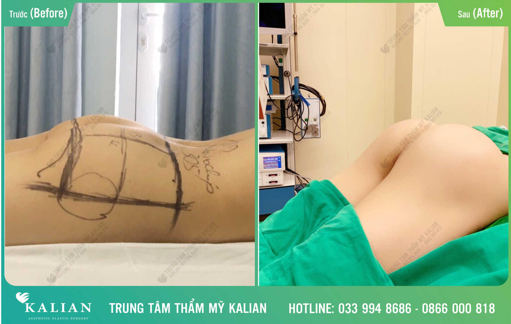 Dịch vụ nâng mông nội soi trung tâm thẩm mỹ Kalian