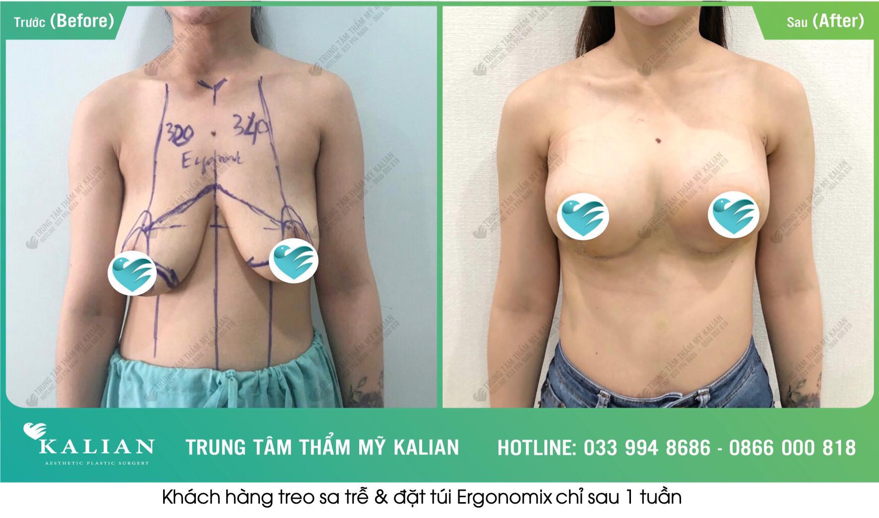 Khách hàng treo se trễ và đặt túi Ergonomix 