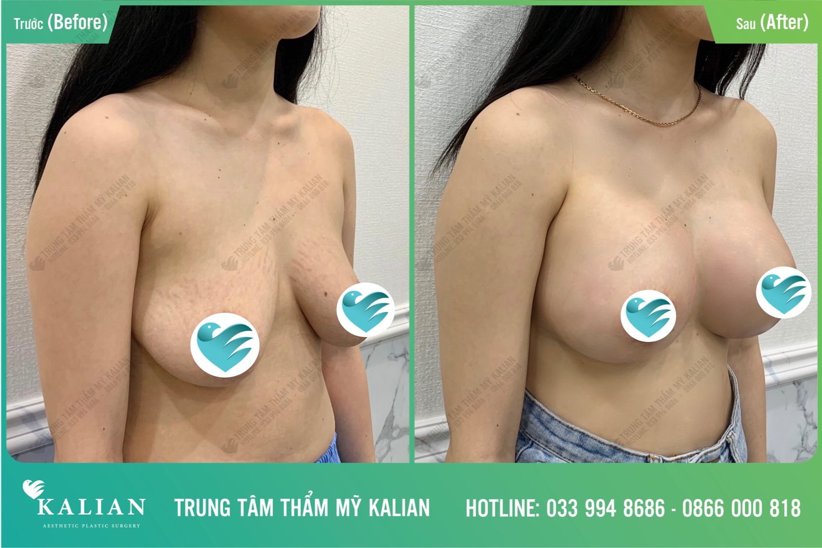 Nâng ngực sa trễ Bác sĩ CKI Hồ Quốc Việt