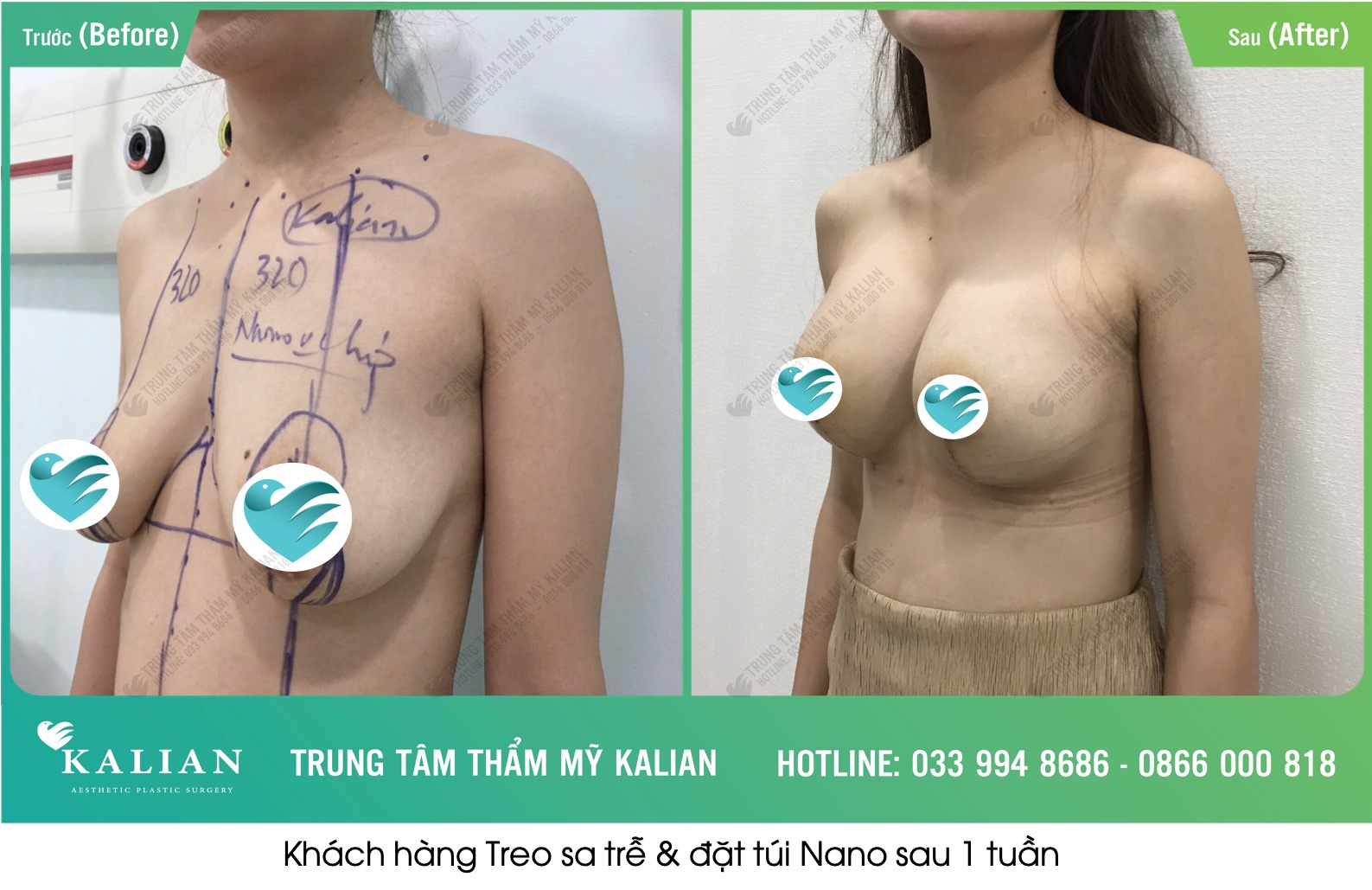 Treo sa trễ - Nâng ngực chảy xệ | Trung tâm thẩm mỹ Kalian