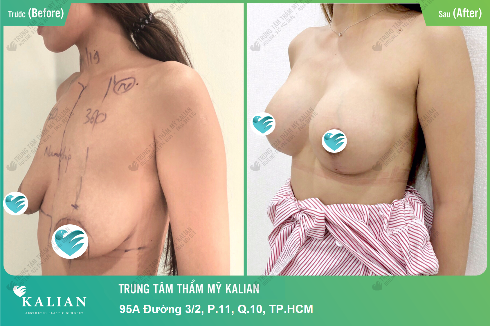 Dịch vụ nâng ngực nội soi trung tâm thẩm mỹ Kalian