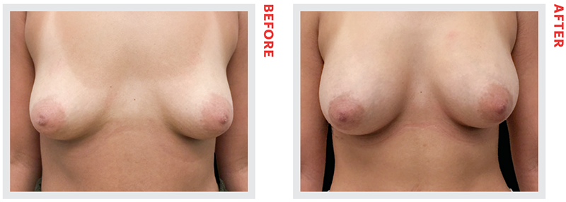 20116-breastaugmentationpng cải thiện vòng một