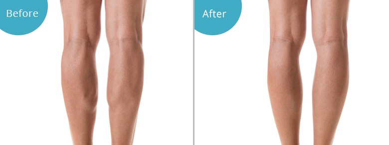 calf_liposuction Những thông tin cần biết về hút mỡ bắp chân