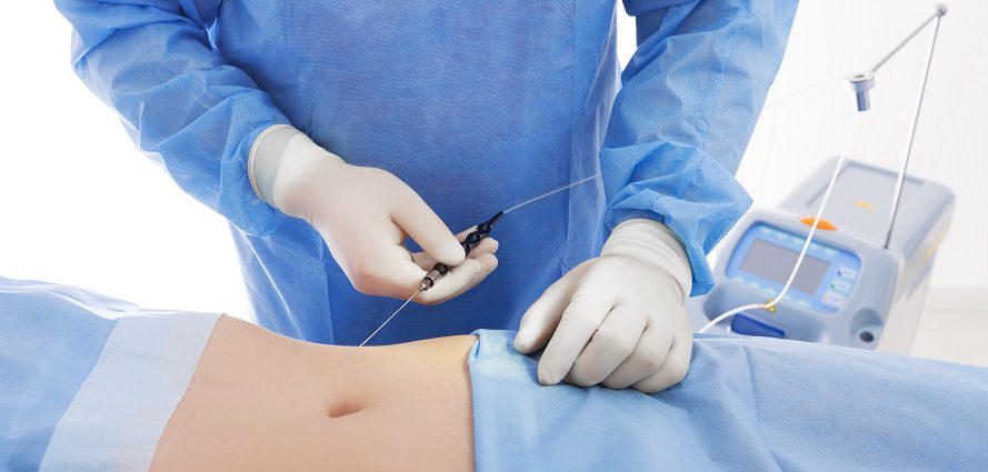Băn khoăn hút mỡ bụng an toàn ở đâu, học ngay bí quyết "chọn mặt gửi vàng" sau đây