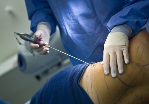hut mo bung phong phau thuat Những điều cần biết về thẩm mỹ hút mỡ an toàn