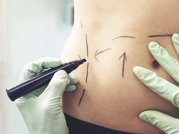 hut mo giam can Giải đáp thắc mắc hút mỡ bụng có nguy hiểm không