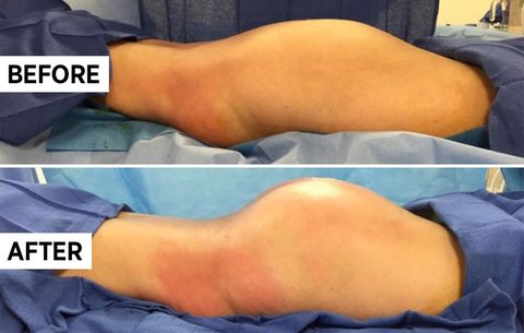 nang mong mo tu than 2 Nâng mông bằng mỡ tự thân: Ưu điểm, Quy trình & Chi phí