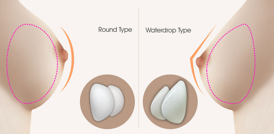 tui tron tui giot nuoc Kiến thức cần biết về nâng ngực túi giọt nước cho phái đẹp