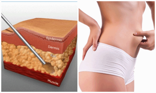 Hướng dẫn chăm sóc sau khi hút mỡ bụng Hướng dẫn chăm sóc sau khi hút mỡ bụng