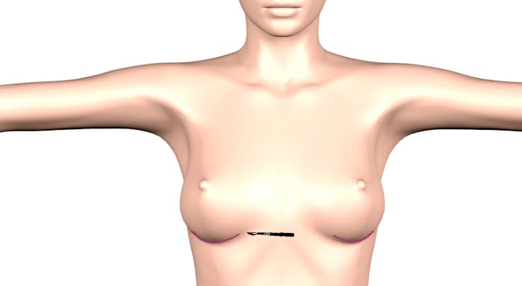 Nâng ngực nội soi đường nào tốt nhất? Nâng ngực nội soi đường nào tốt nhất?
