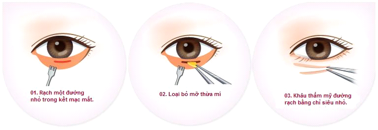 Phẫu thuật thẩm mỹ mắt và những thông tin hữu ích cho phái đẹp Phẫu thuật thẩm mỹ mắt và những thông tin hữu ích cho phái đẹp