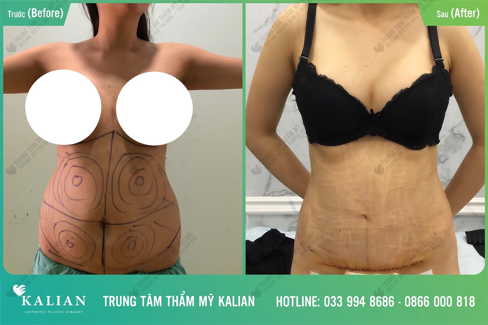 căng da bụng thoàn phần căng da bụng thoàn phần