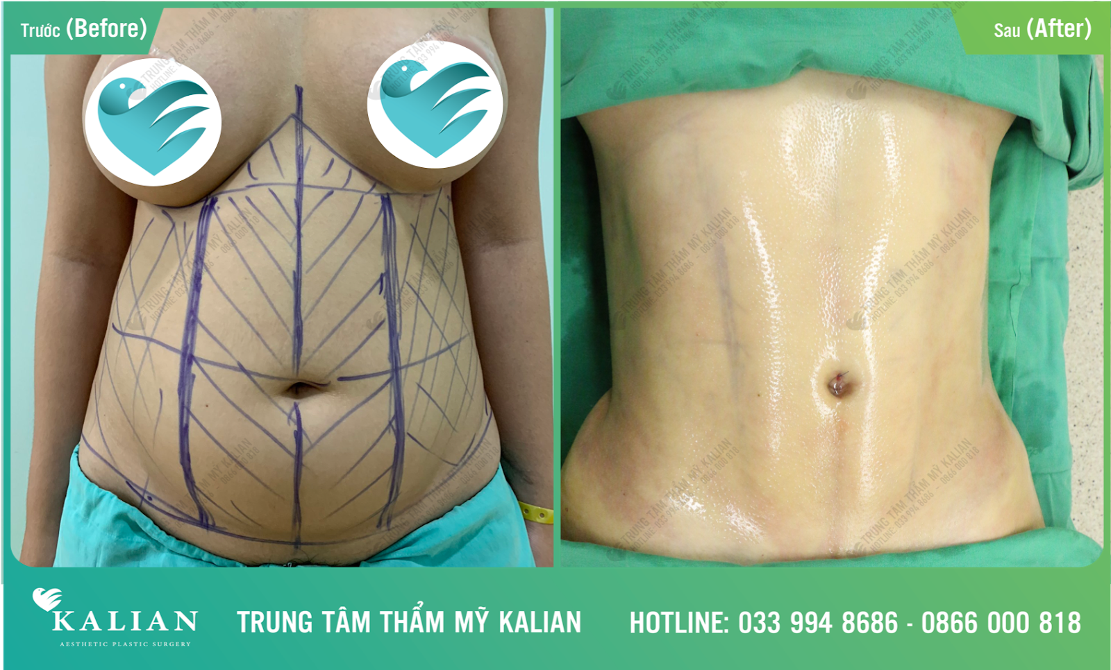 bụng trước sau