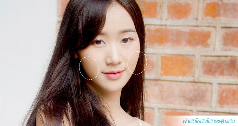 lấy mỡ má 1 lấy mỡ má 1