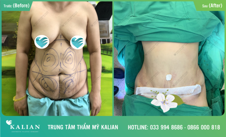 hút mỡ toàn thân 2 hút mỡ toàn thân