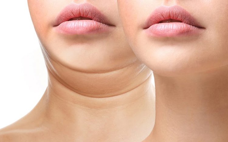 hút mỡ nọng cằm BS Việt hút mỡ nọng cằm BS Việt