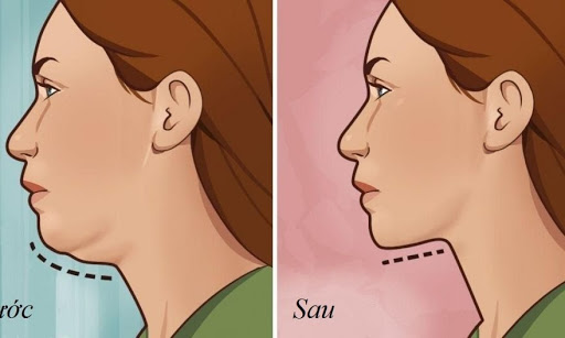 Hút mỡ nọng cằm hiệu quả nhanh chóng Hút mỡ nọng cằm hiệu quả nhanh chóng
