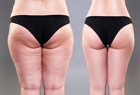 hút mỡ đùi bao nhiêu tiền