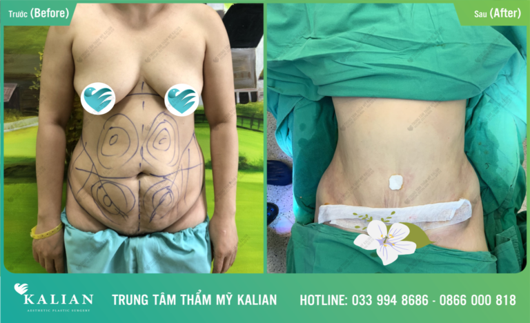 hut-mỡ-bụng-bác-sĩ-việt