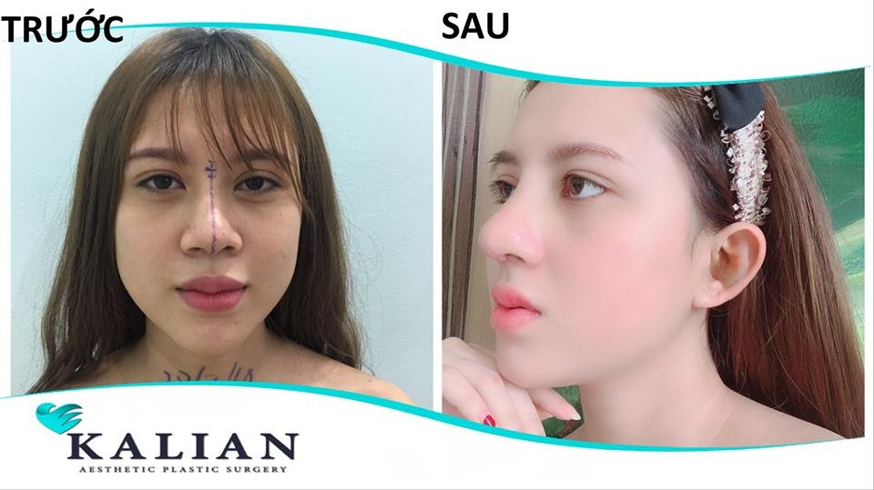 nang mui cau truc2